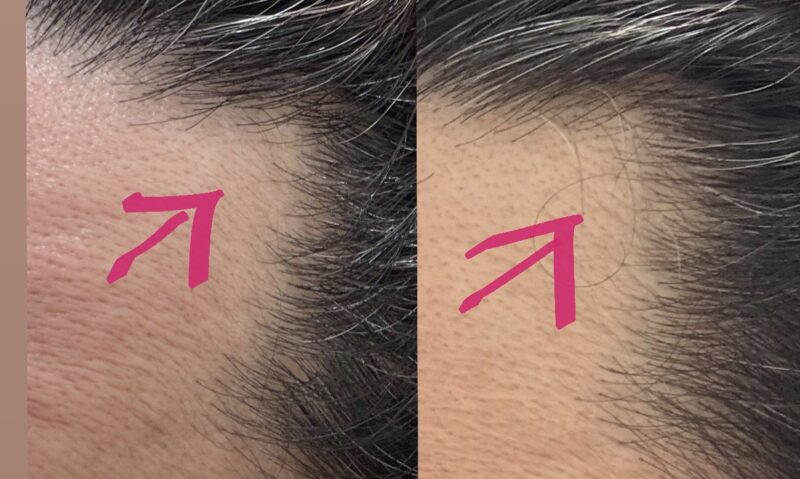 薄毛比較